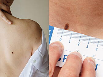 The ABCDE To Minding Your Skin...